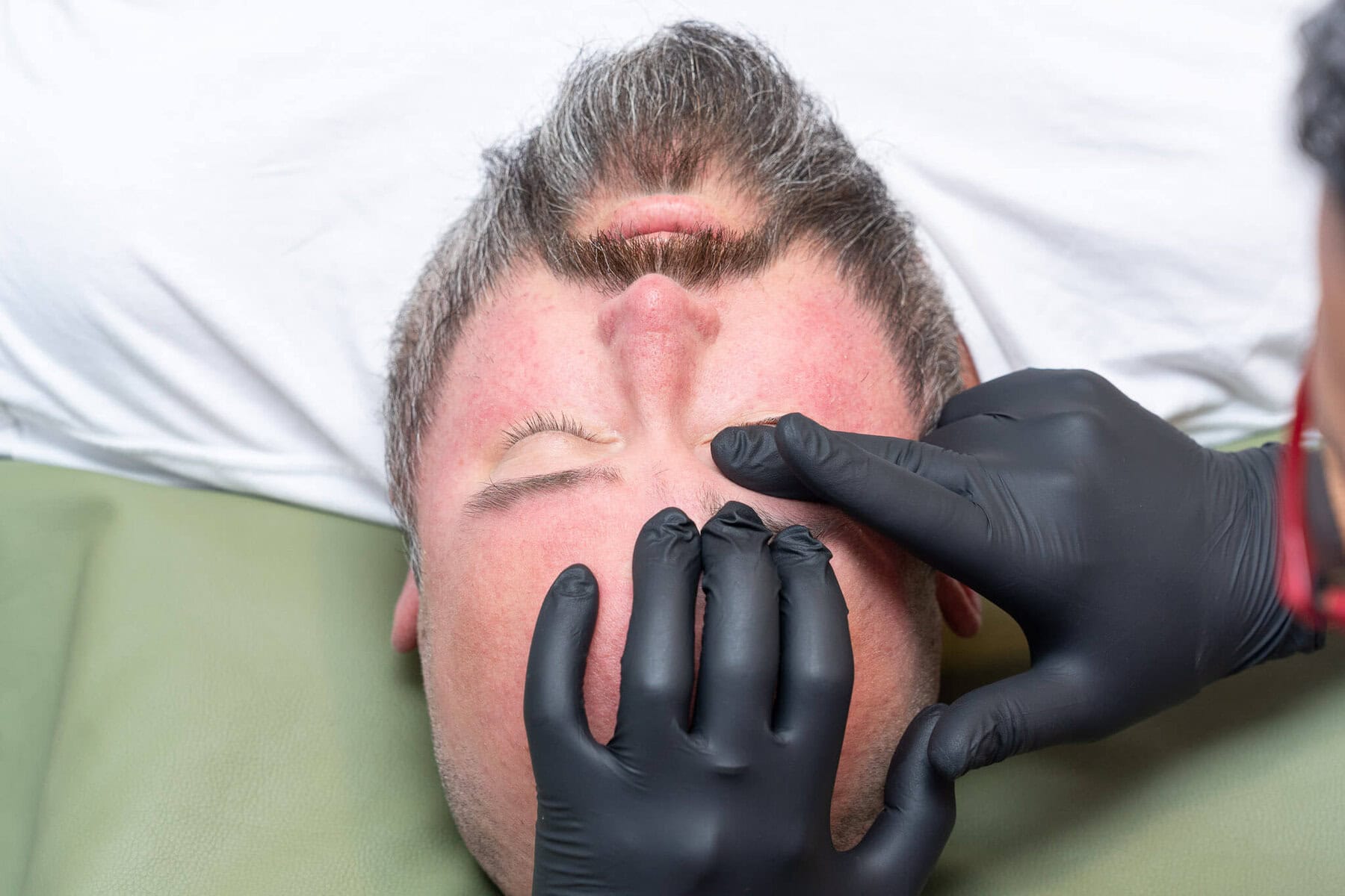 Butheau Facialparalysis
